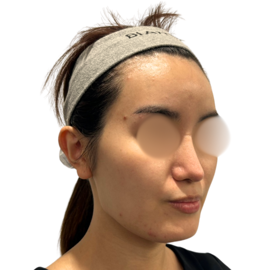 バイオリピール（ミラノリピール）